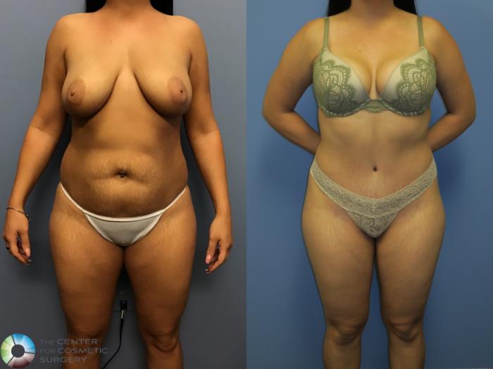 Before & After Tummy Tuck Case 11400 Front View in Golden, CO