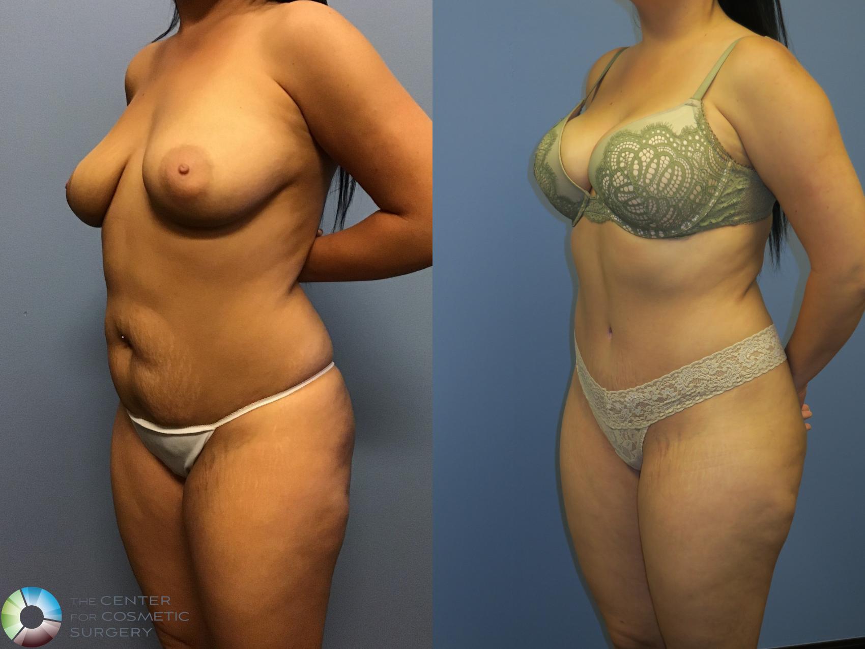 Before & After Tummy Tuck Case 11400 Left Oblique View in Golden, CO