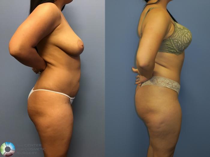 Before & After Tummy Tuck Case 11400 Right Side View in Golden, CO