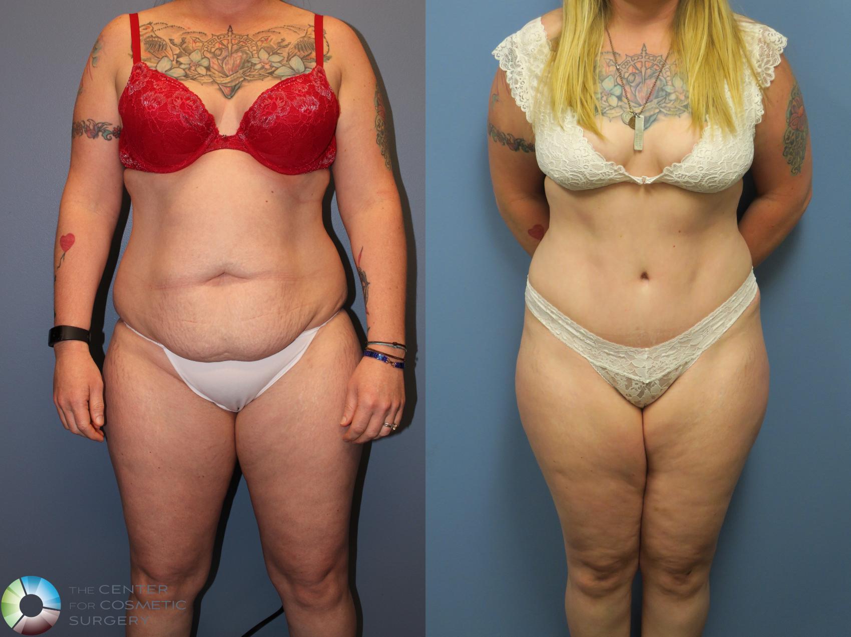 Before & After Tummy Tuck Case 11401 Front in Denver and Colorado Springs, CO