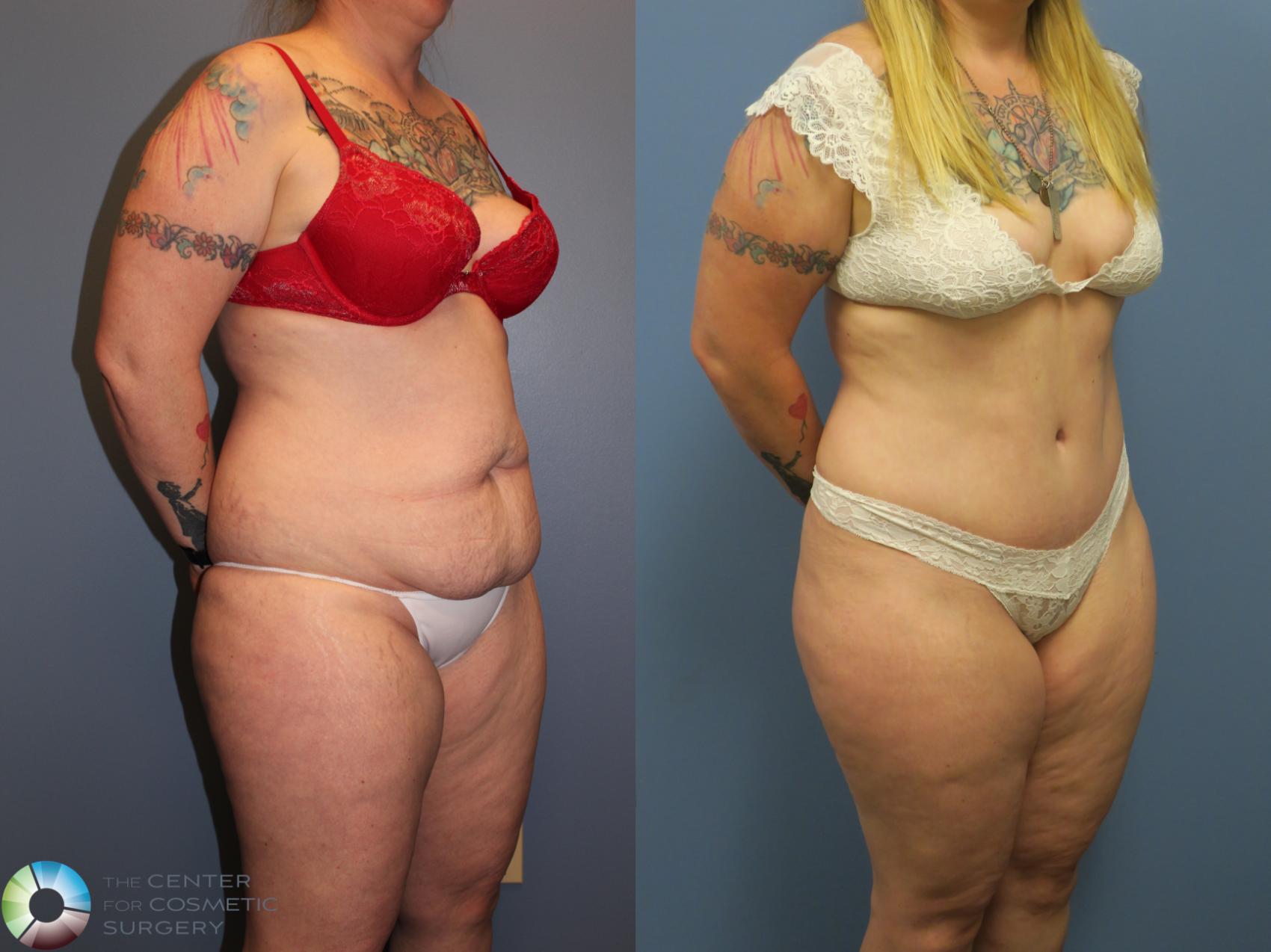 Before & After Tummy Tuck Case 11401 Right Oblique in Denver and Colorado Springs, CO