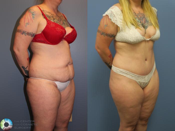 Before & After Tummy Tuck Case 11401 Right Oblique in Denver, CO