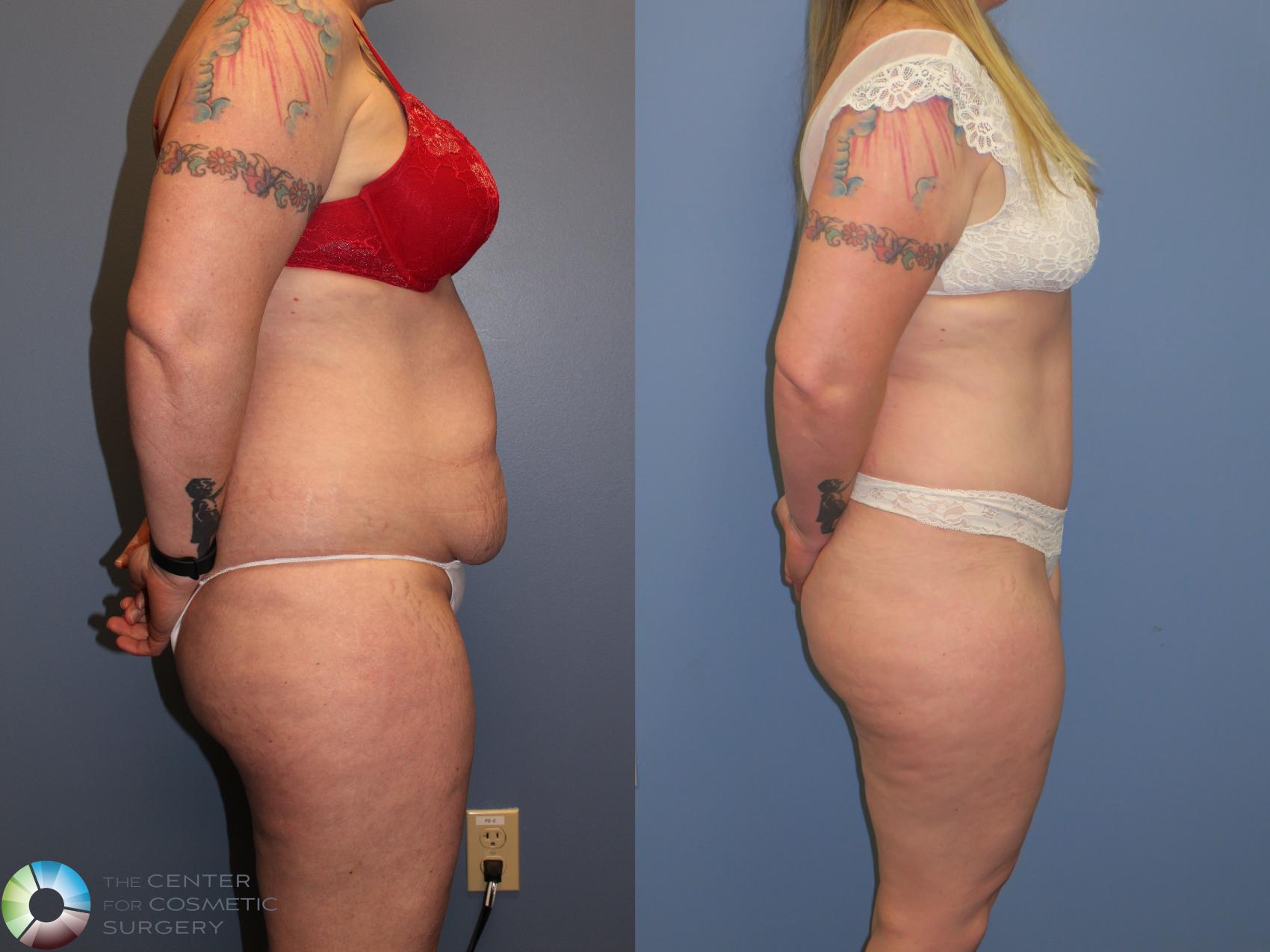Before & After Tummy Tuck Case 11401 Right Side in Denver and Colorado Springs, CO