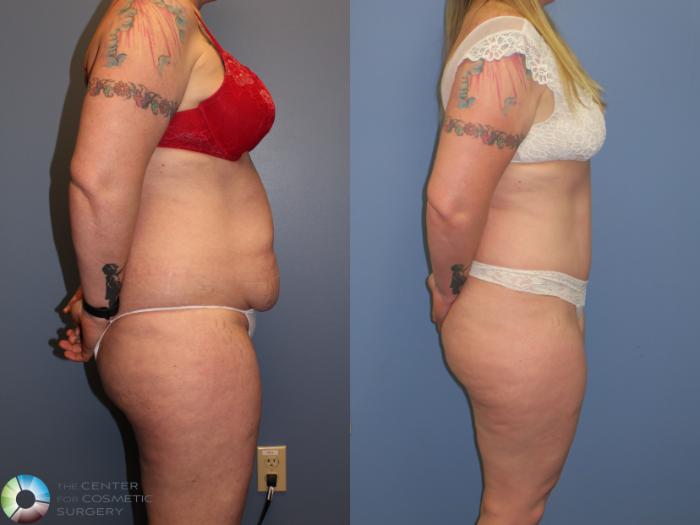 Before & After Tummy Tuck Case 11401 Right Side in Denver, CO