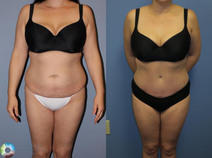 Before & After Tummy Tuck Case 11402 Front View in Golden, CO
