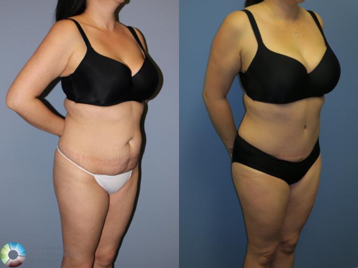 Before & After Tummy Tuck Case 11402 Right Oblique View in Golden, CO