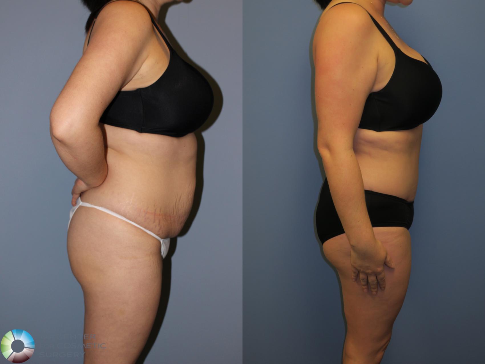Before & After Tummy Tuck Case 11402 Right Side in Denver and Colorado Springs, CO