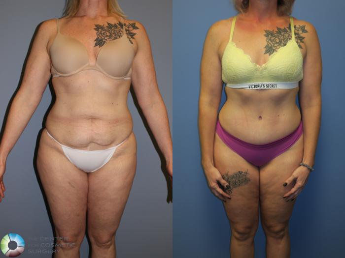 Before & After Tummy Tuck Case 11403 Front in Denver and Colorado Springs, CO