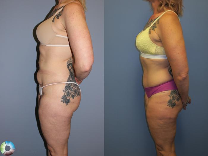 Before & After Tummy Tuck Case 11403 Left Side in Denver and Colorado Springs, CO