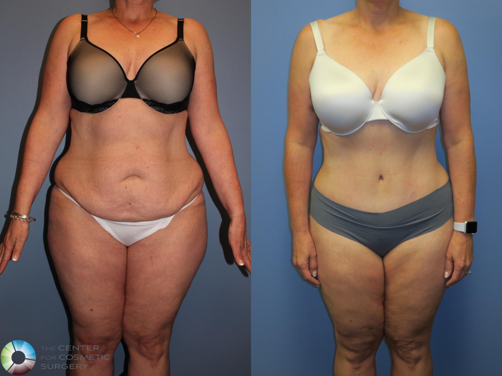 Before & After Tummy Tuck Case 11404 Front in Denver and Colorado Springs, CO