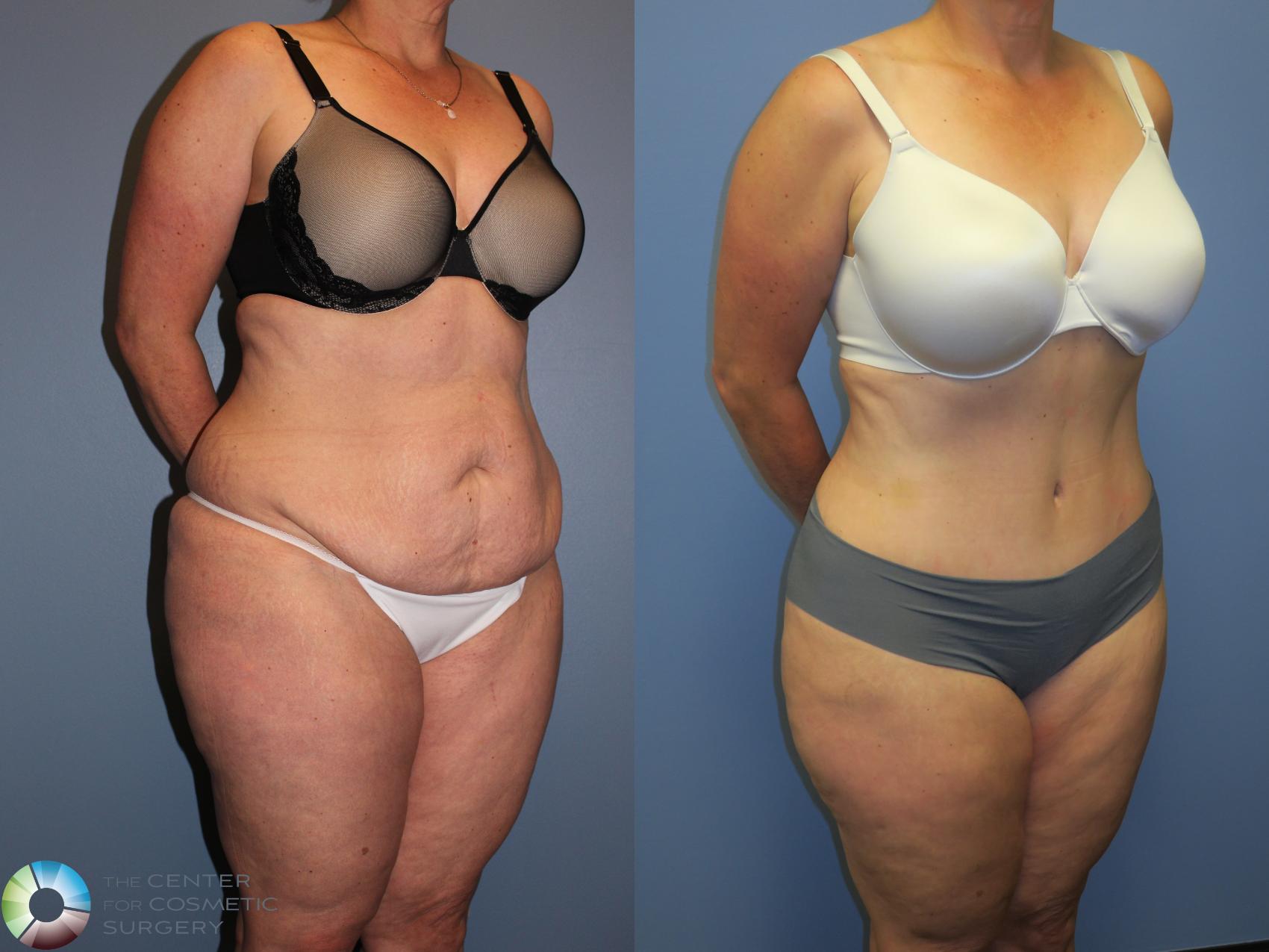 Before & After Tummy Tuck Case 11404 Right Oblique View in Golden, CO