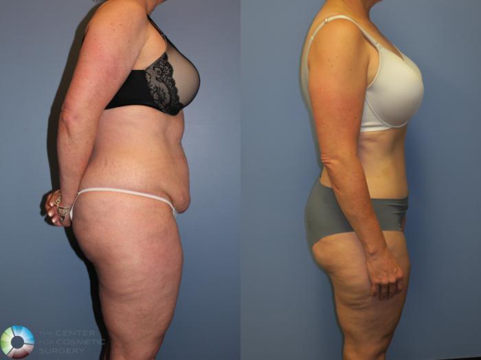 Before & After Tummy Tuck Case 11404 Right Side in Denver, CO
