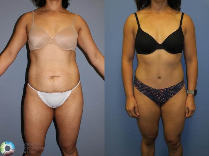 Before & After Tummy Tuck Case 11405 Front View in Golden, CO