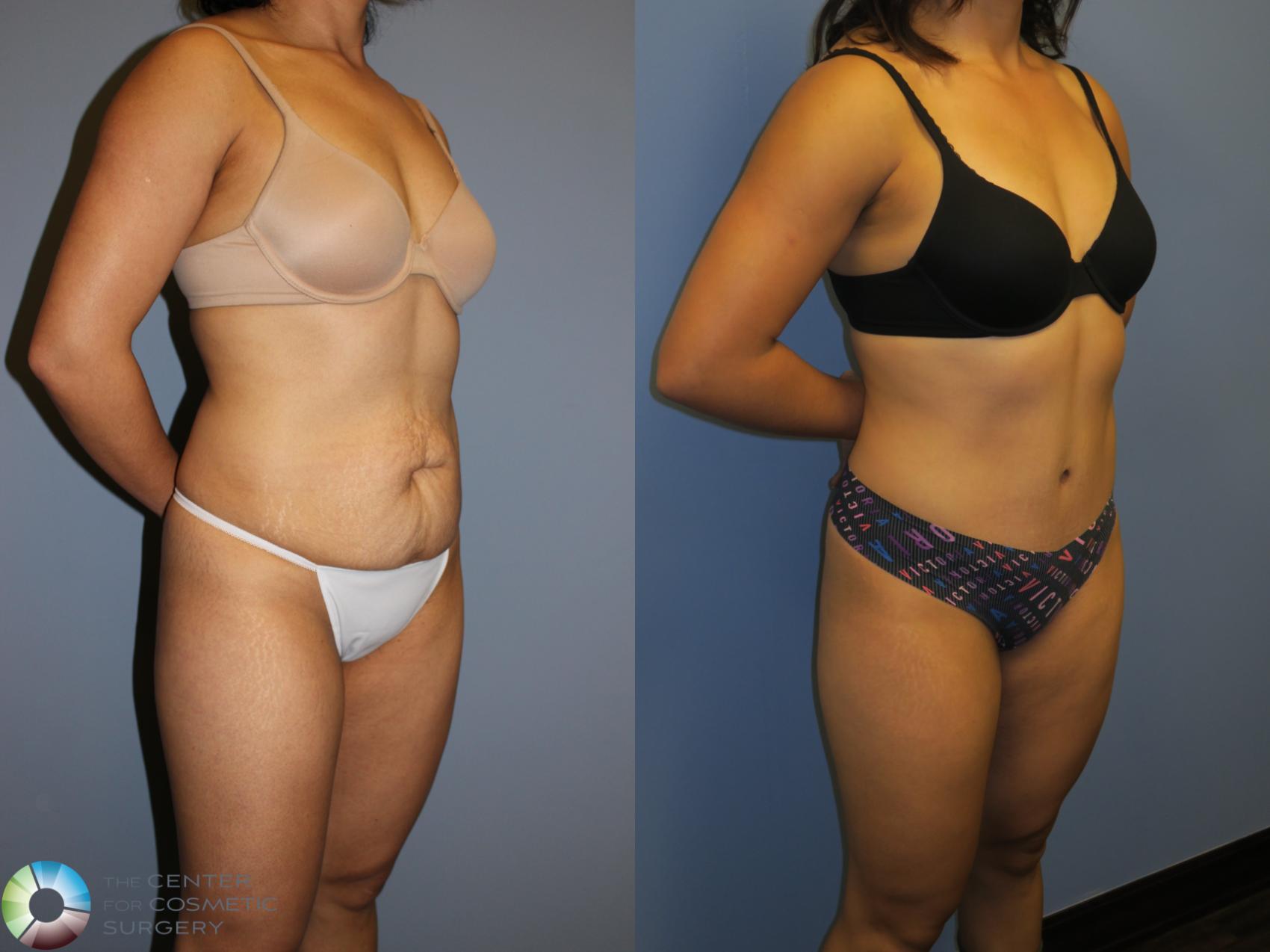 Before & After Tummy Tuck Case 11405 Right Oblique View in Golden, CO