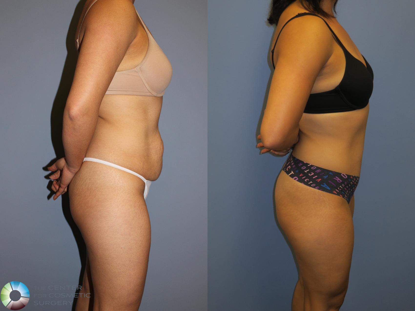 Before & After Tummy Tuck Case 11405 Right Side View in Golden, CO