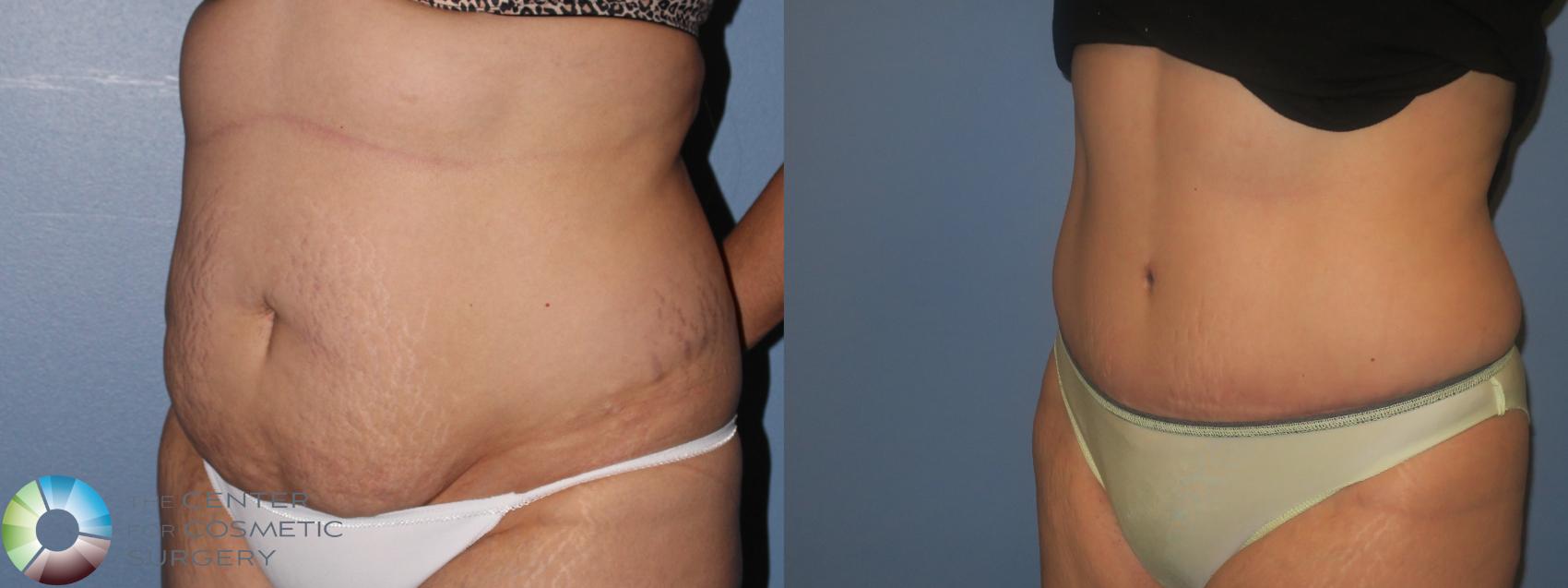 Before & After Tummy Tuck Case 11457 Left Oblique in Denver and Colorado Springs, CO