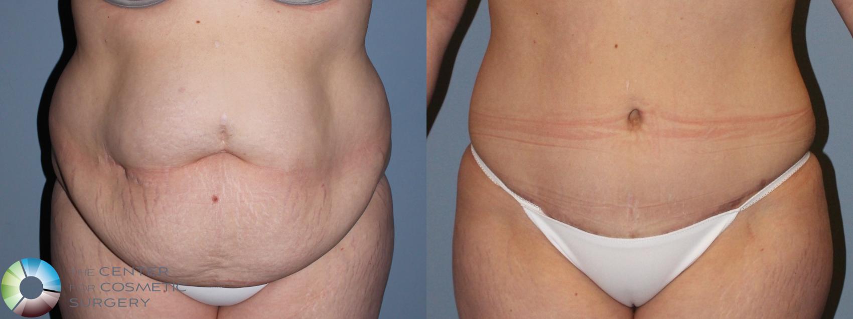 Before & After Tummy Tuck Case 11459 Front in Denver and Colorado Springs, CO
