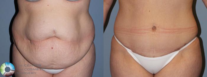 Before & After Tummy Tuck Case 11459 Front in Denver and Colorado Springs, CO