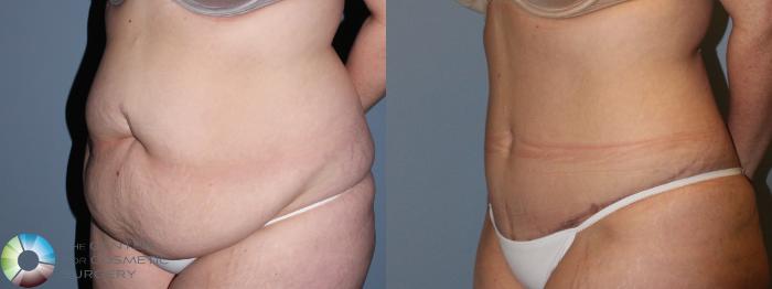 Before & After Tummy Tuck Case 11459 Left Oblique in Denver and Colorado Springs, CO