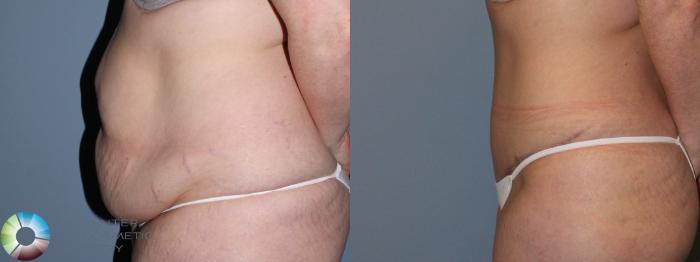 Before & After Tummy Tuck Case 11459 Left Side in Denver and Colorado Springs, CO