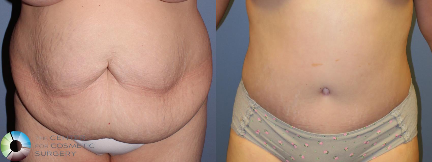 Before & After Tummy Tuck Case 11461 Front View in Golden, CO