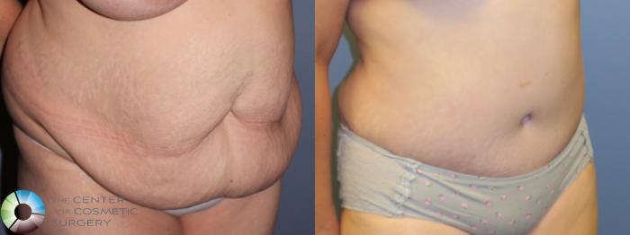 Before & After Tummy Tuck Case 11461 Right Oblique View in Golden, CO