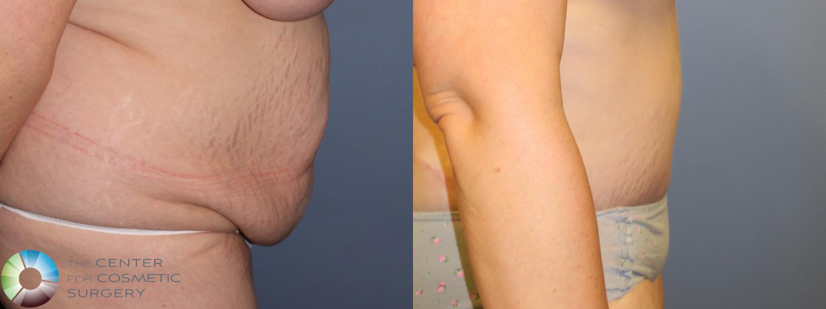 Before & After Tummy Tuck Case 11461 Right Side in Denver and Colorado Springs, CO