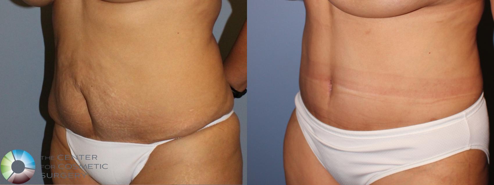 Before & After Tummy Tuck Case 11463 Left Oblique in Denver and Colorado Springs, CO