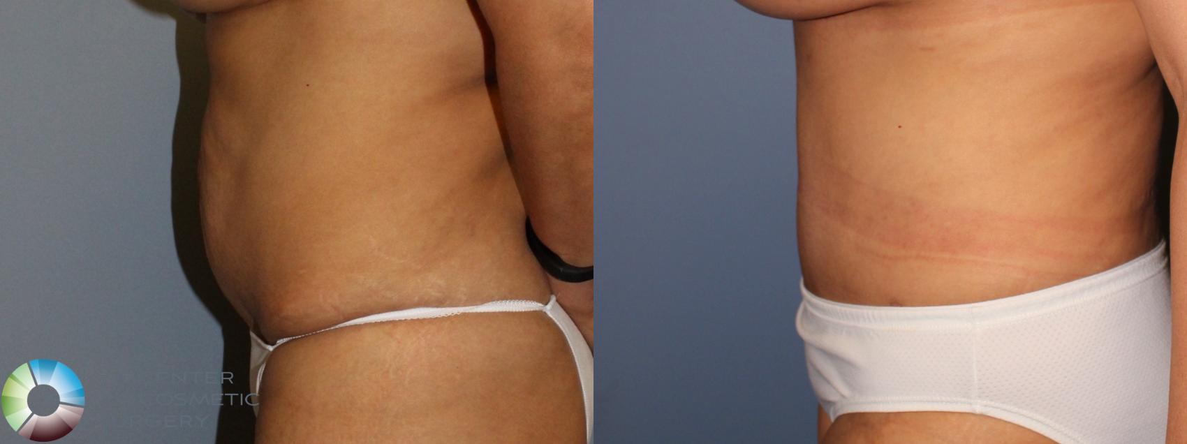Before & After Tummy Tuck Case 11463 Left Side in Denver and Colorado Springs, CO