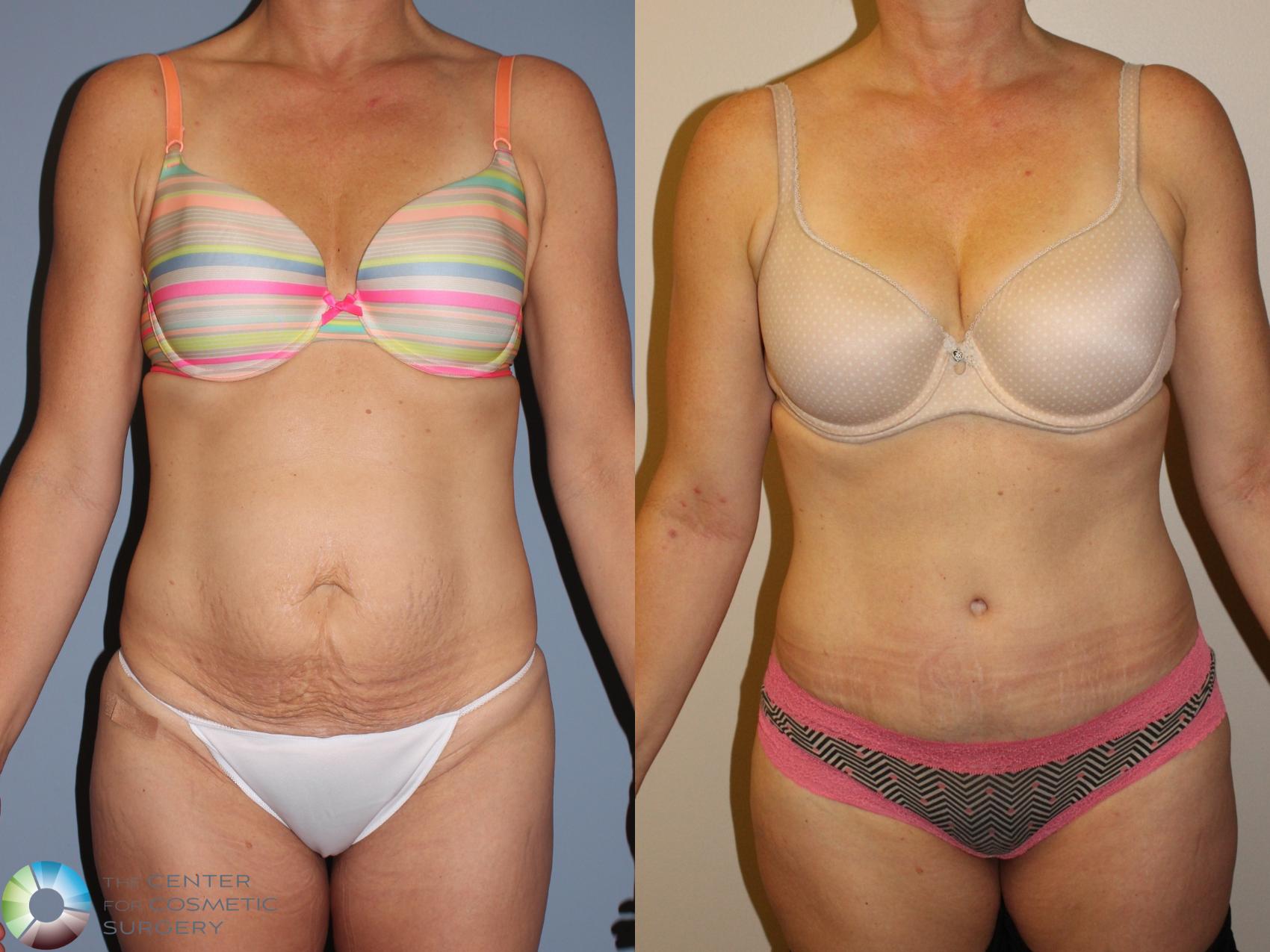 Before & After Tummy Tuck Case 11494 Front View in Golden, CO