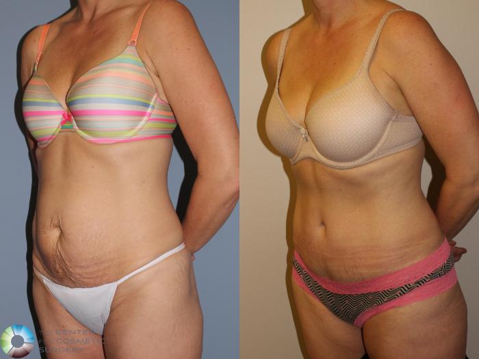 Before & After Tummy Tuck Case 11494 Left Oblique View in Golden, CO