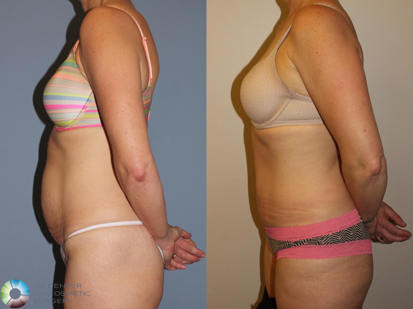 Before & After Tummy Tuck Case 11494 Left Side in Denver and Colorado Springs, CO