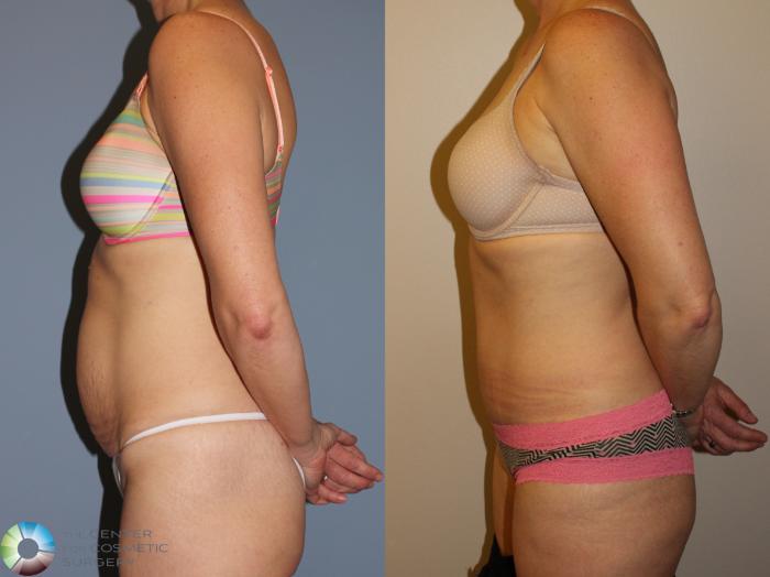 Before & After Tummy Tuck Case 11494 Left Side View in Golden, CO