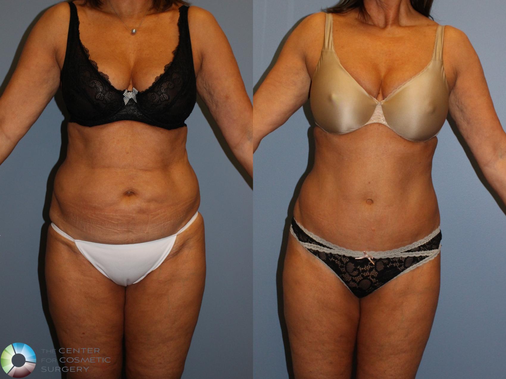 Before & After Tummy Tuck Case 11504 Front View in Golden, CO