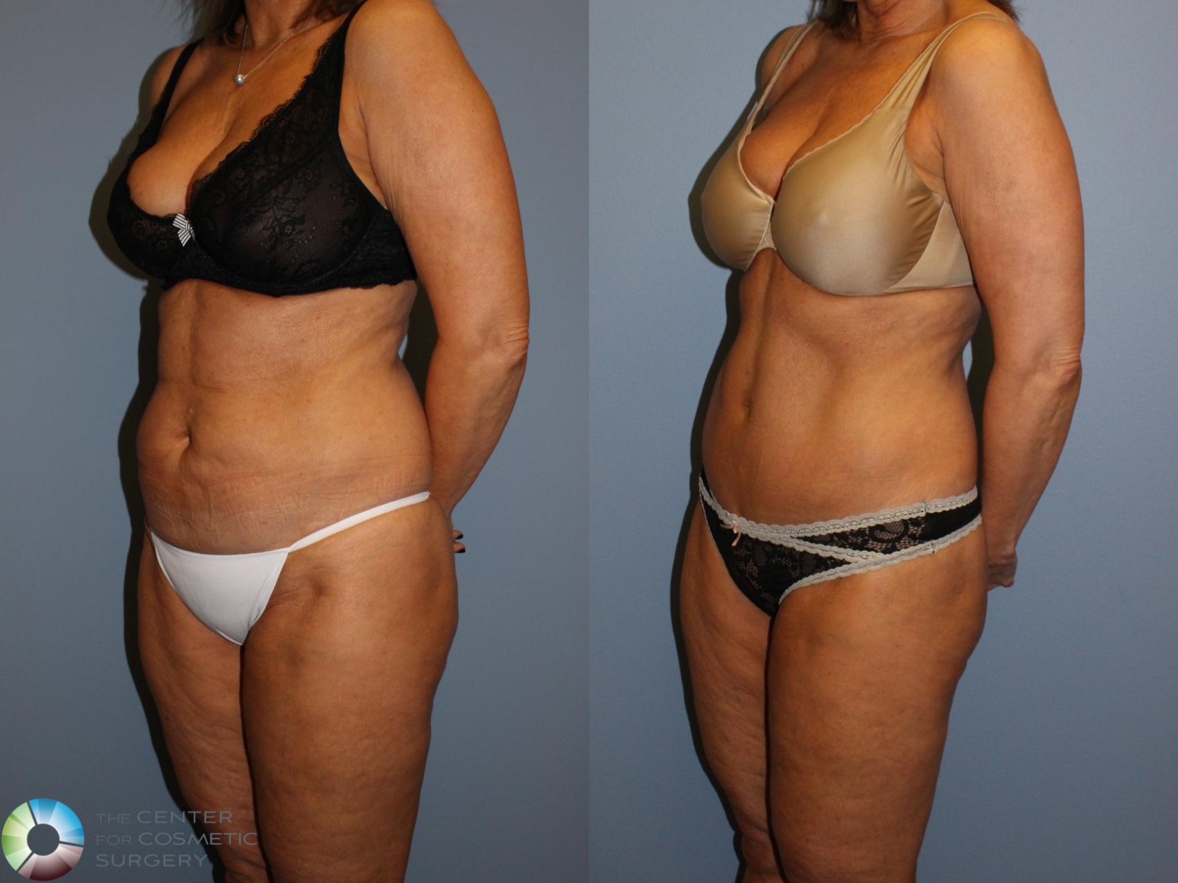 Before & After Tummy Tuck Case 11504 Left Oblique View in Golden, CO