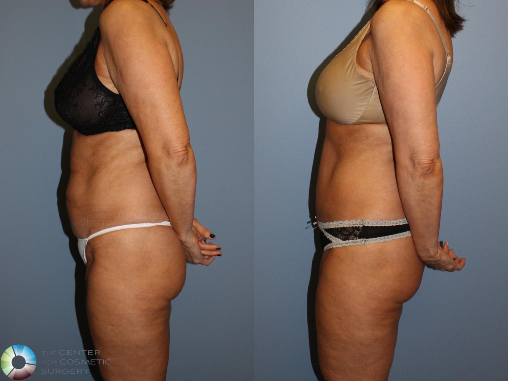 Before & After Tummy Tuck Case 11504 Left Side View in Golden, CO
