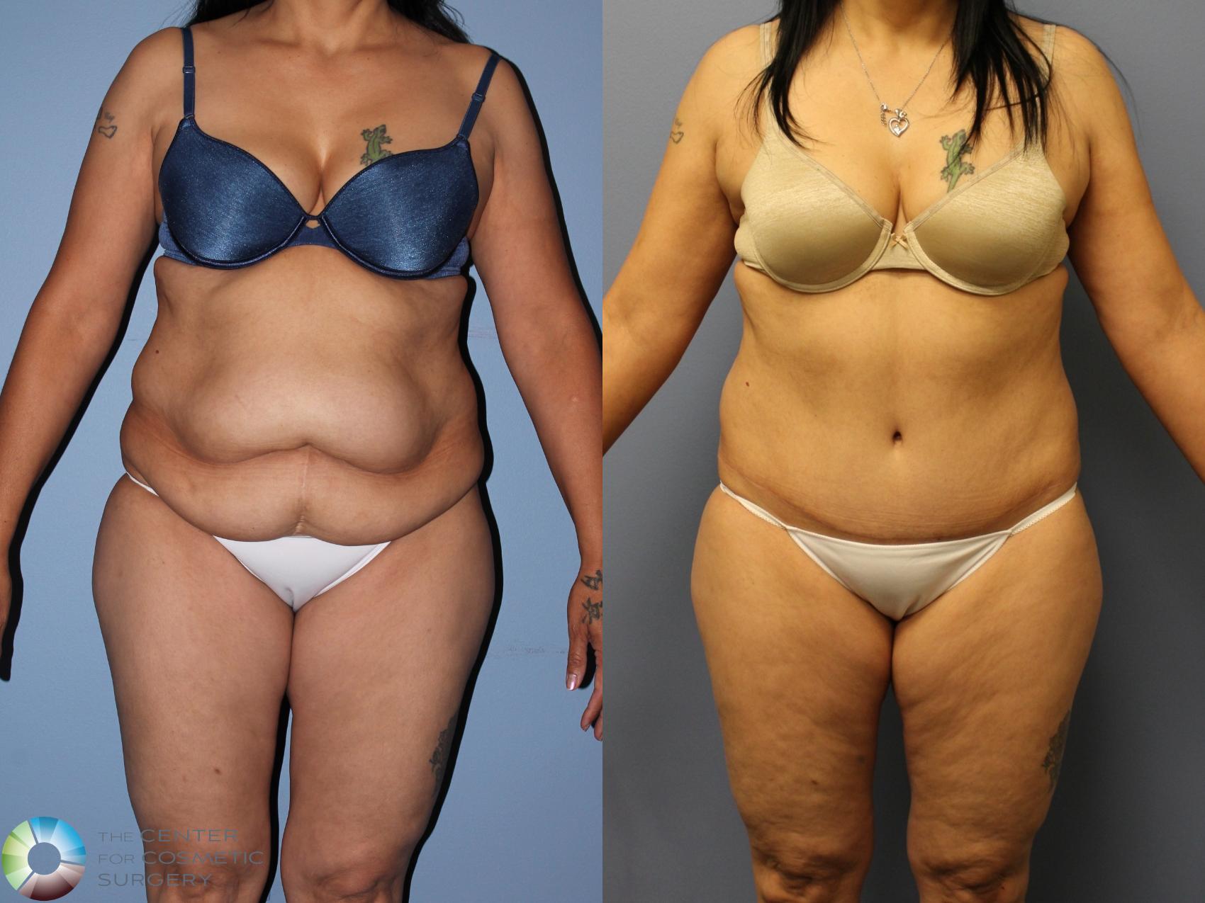 Before & After Tummy Tuck Case 11522 Front in Denver and Colorado Springs, CO