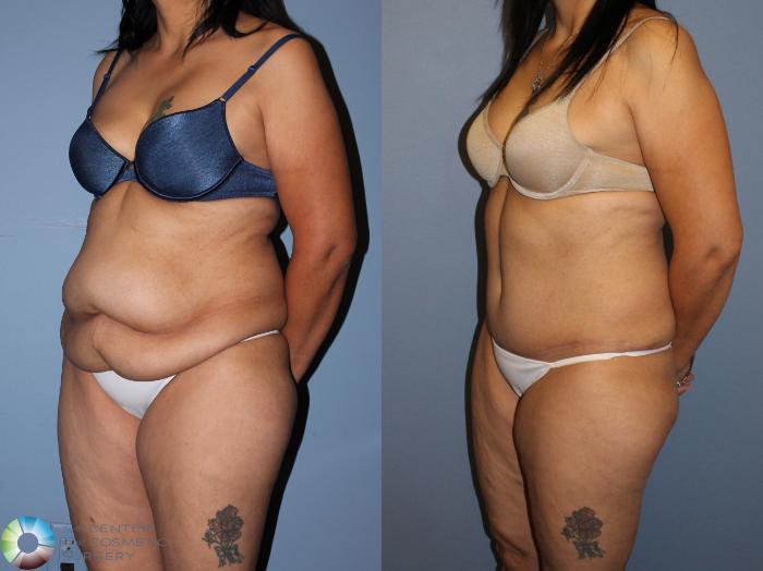 Before & After Tummy Tuck Case 11522 Left Oblique View in Golden, CO