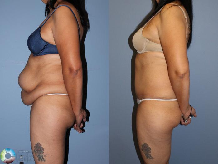 Before & After Tummy Tuck Case 11522 Left Side View in Golden, CO