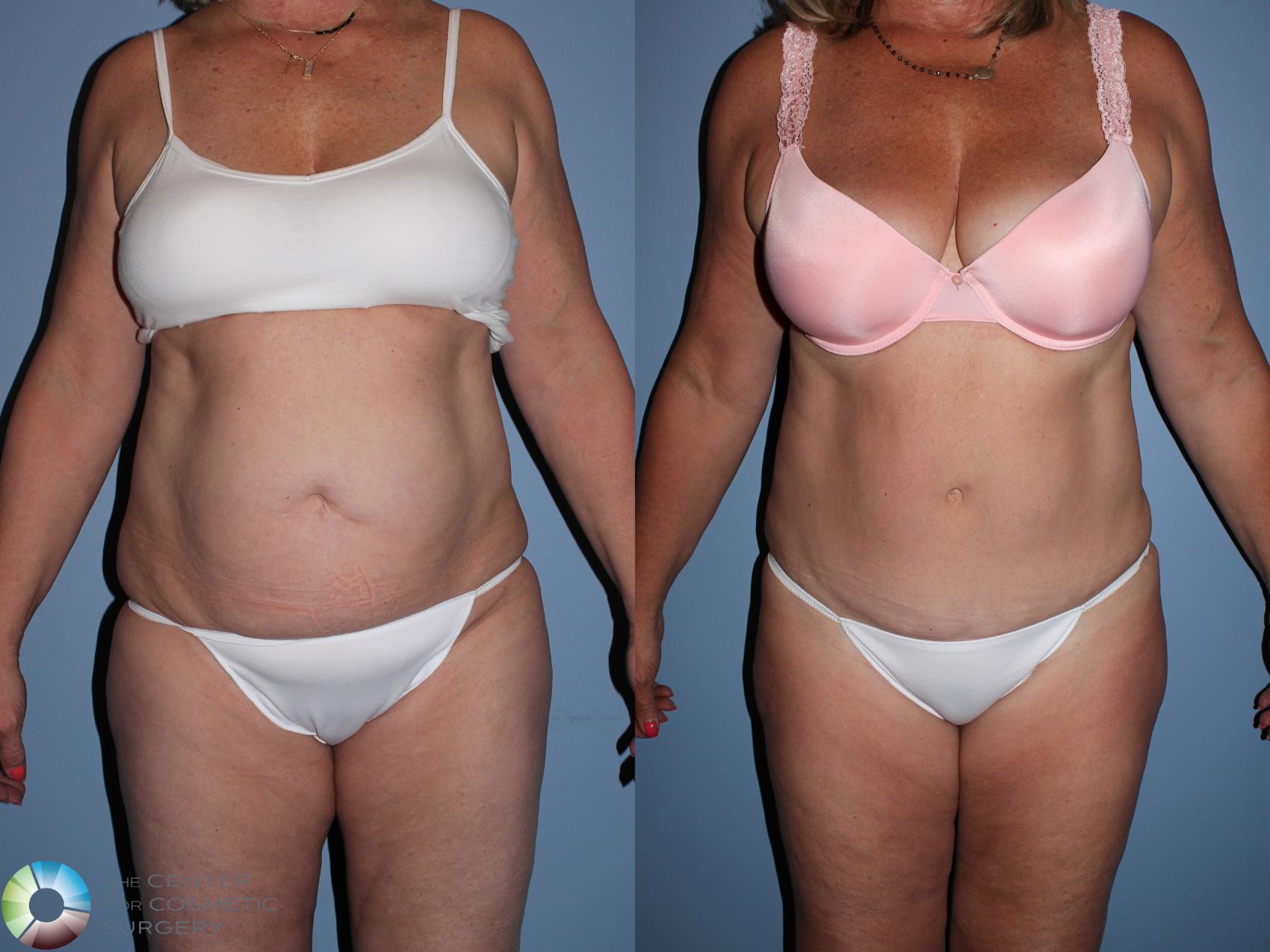 Before & After Tummy Tuck Case 11524 Front View in Golden, CO