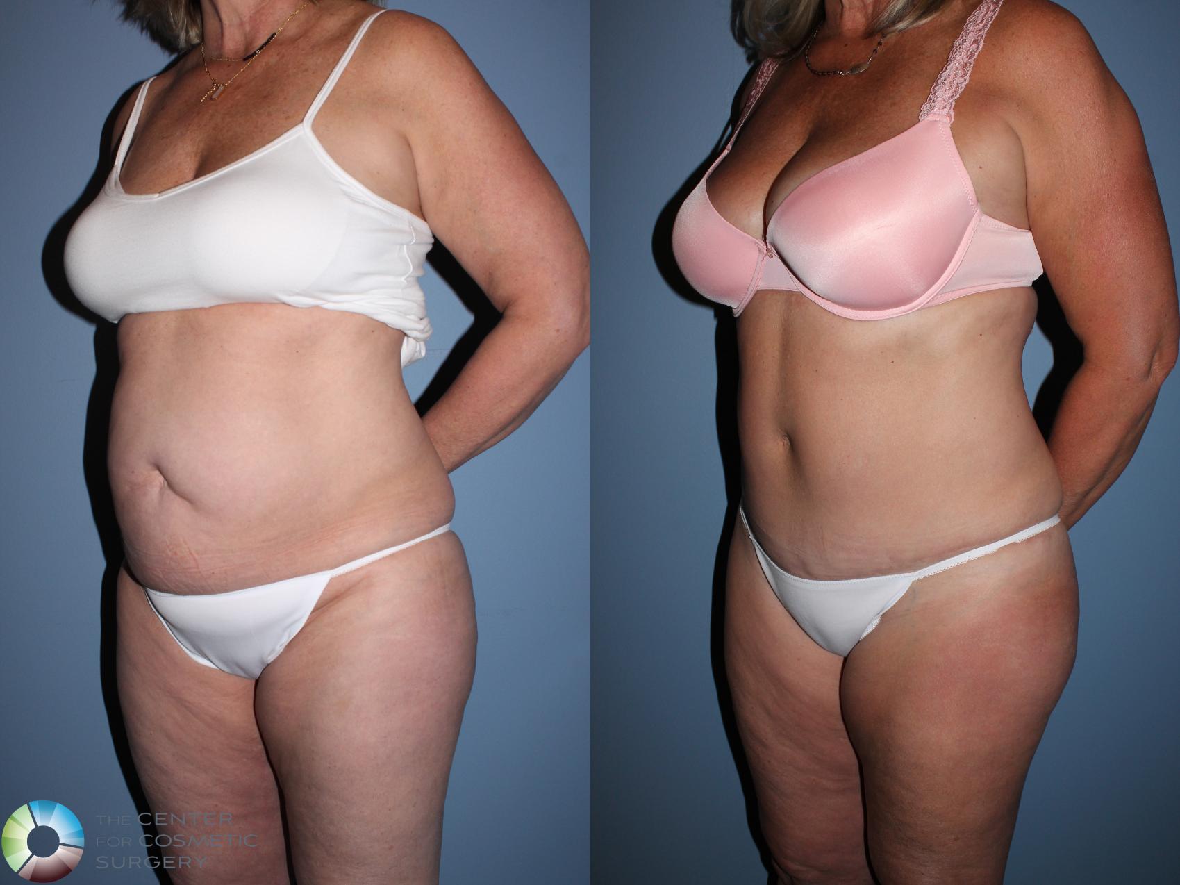 Before & After Tummy Tuck Case 11524 Left Oblique View in Golden, CO