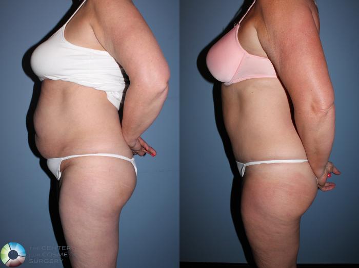 Before & After Tummy Tuck Case 11524 Left Side View in Golden, CO