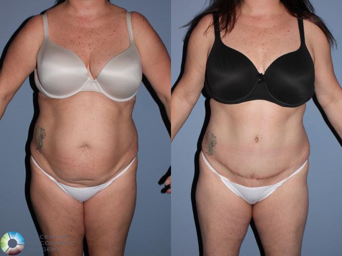 Before & After Tummy Tuck Case 11533 Front View in Golden, CO