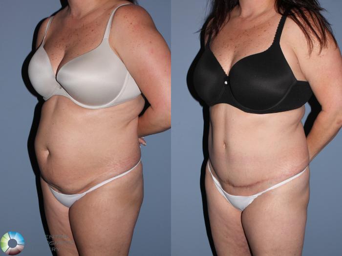 Before & After Tummy Tuck Case 11533 Left Oblique View in Golden, CO