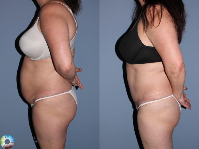 Before & After Tummy Tuck Case 11533 Left Side View in Golden, CO