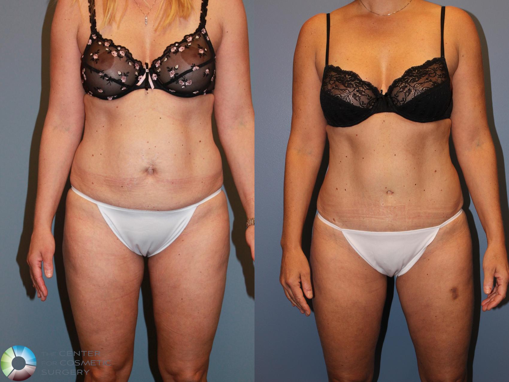 Before & After Tummy Tuck Case 11537 Front View in Golden, CO