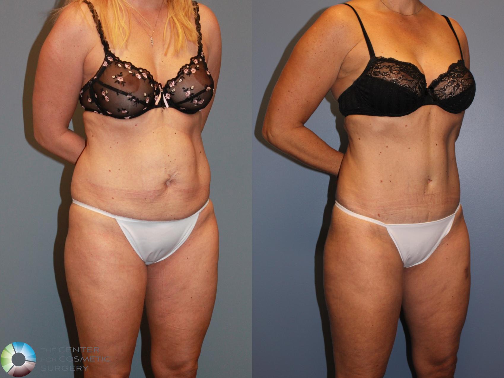 Before & After Liposuction Case 11537 Right Oblique View in Denver & Golden, CO