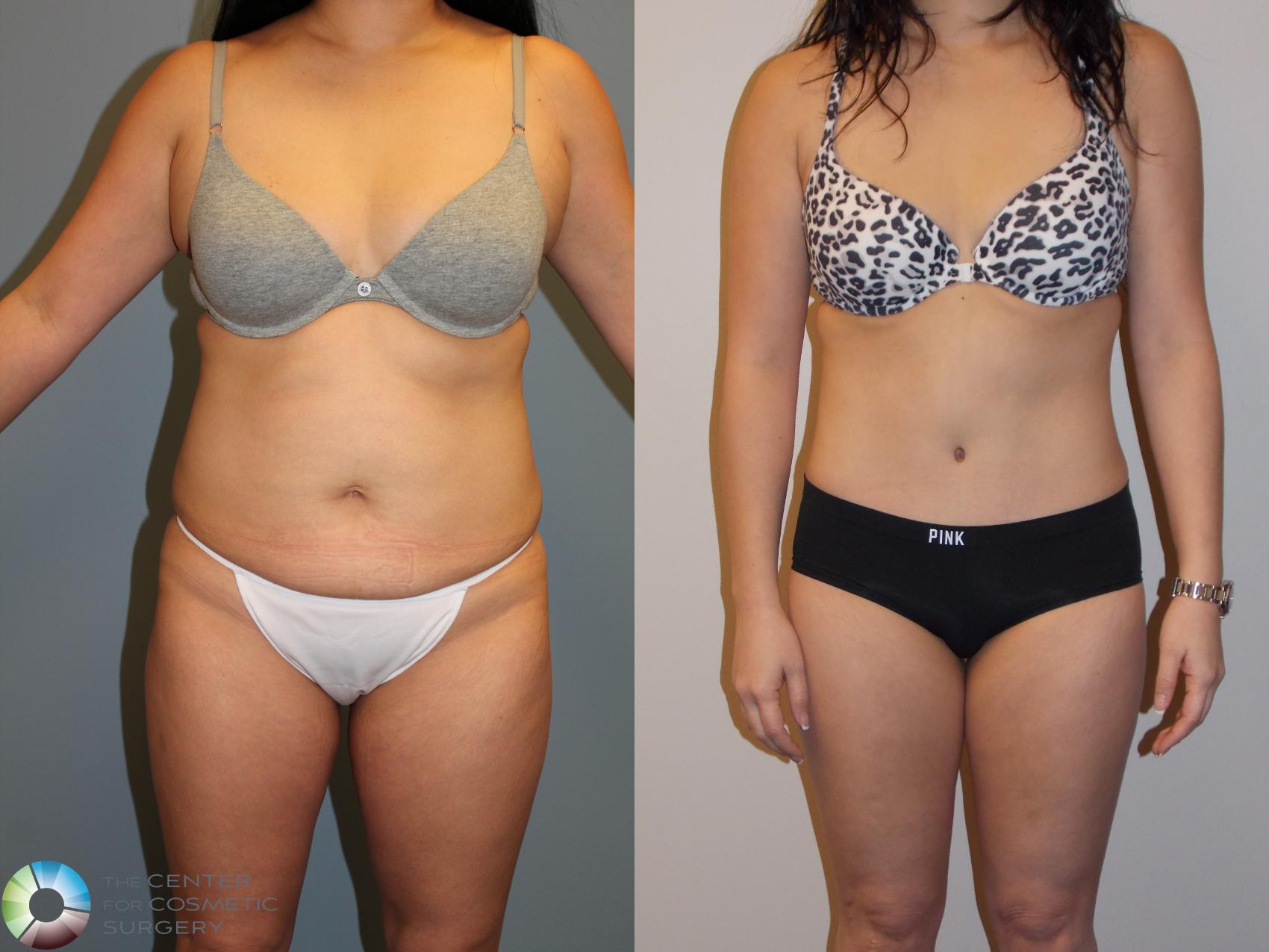 Before & After Tummy Tuck Case 11538 Front View in Golden, CO