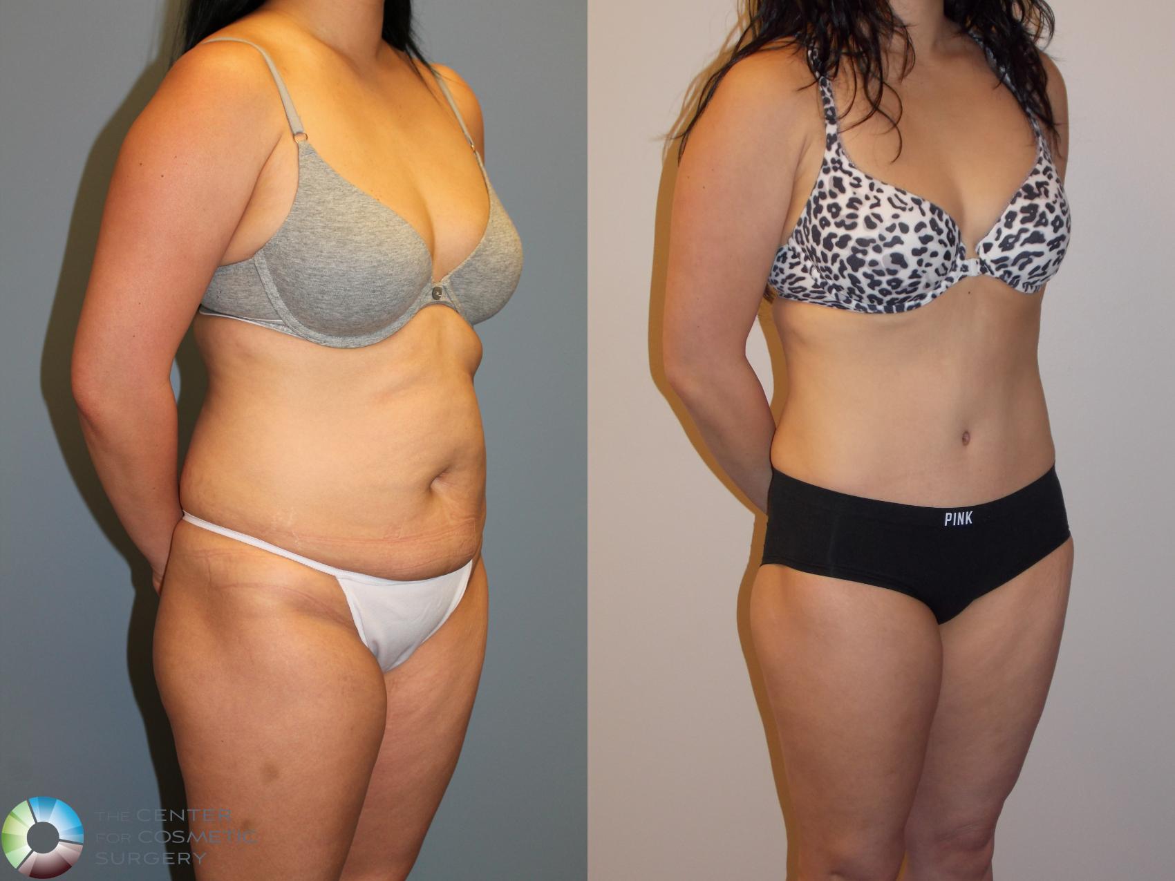 Before & After Tummy Tuck Case 11538 Right Oblique View in Golden, CO