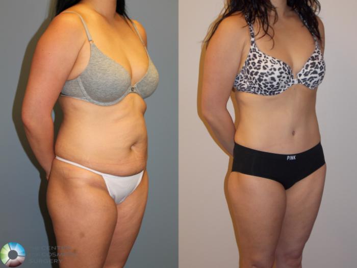 Before & After Tummy Tuck Case 11538 Right Oblique in Denver and Colorado Springs, CO